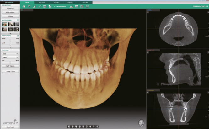 Аппарат рентгеновский дентальный цифровой панорамный Smart Plus с функцией КТ и Цефалостатом .